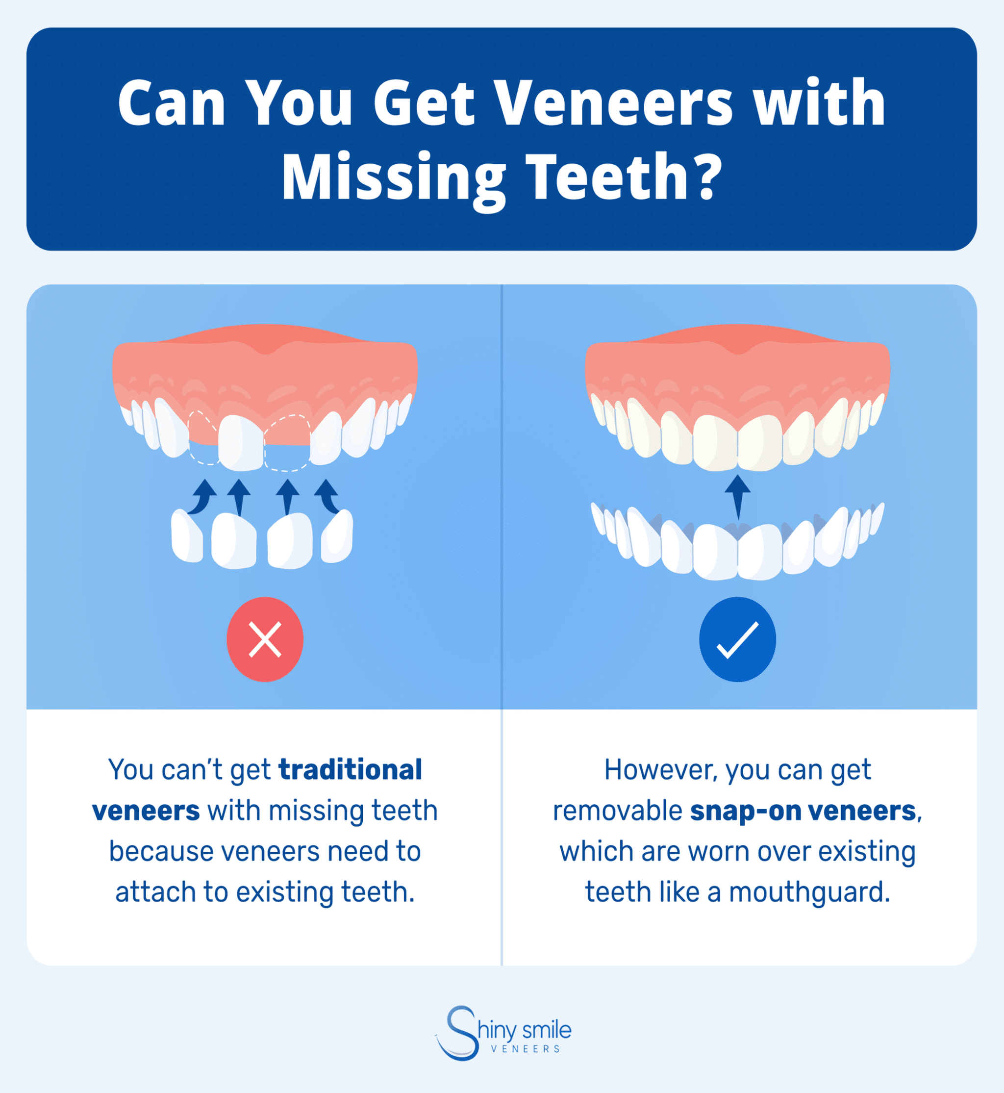 can you get veneers with missing teeth